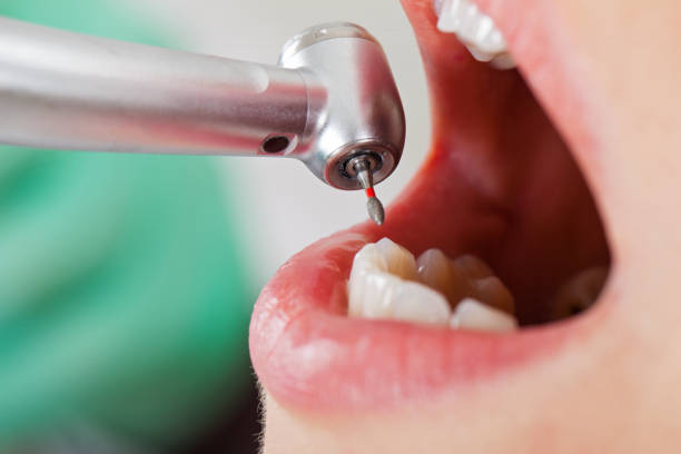 Best Emergency Dentist for Lost Fillings or Crowns in Camanche, IA